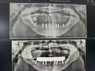 All-on-6 panoramski RTG snimak, šest implantata u vilici, implantologija Cazin, Ridental