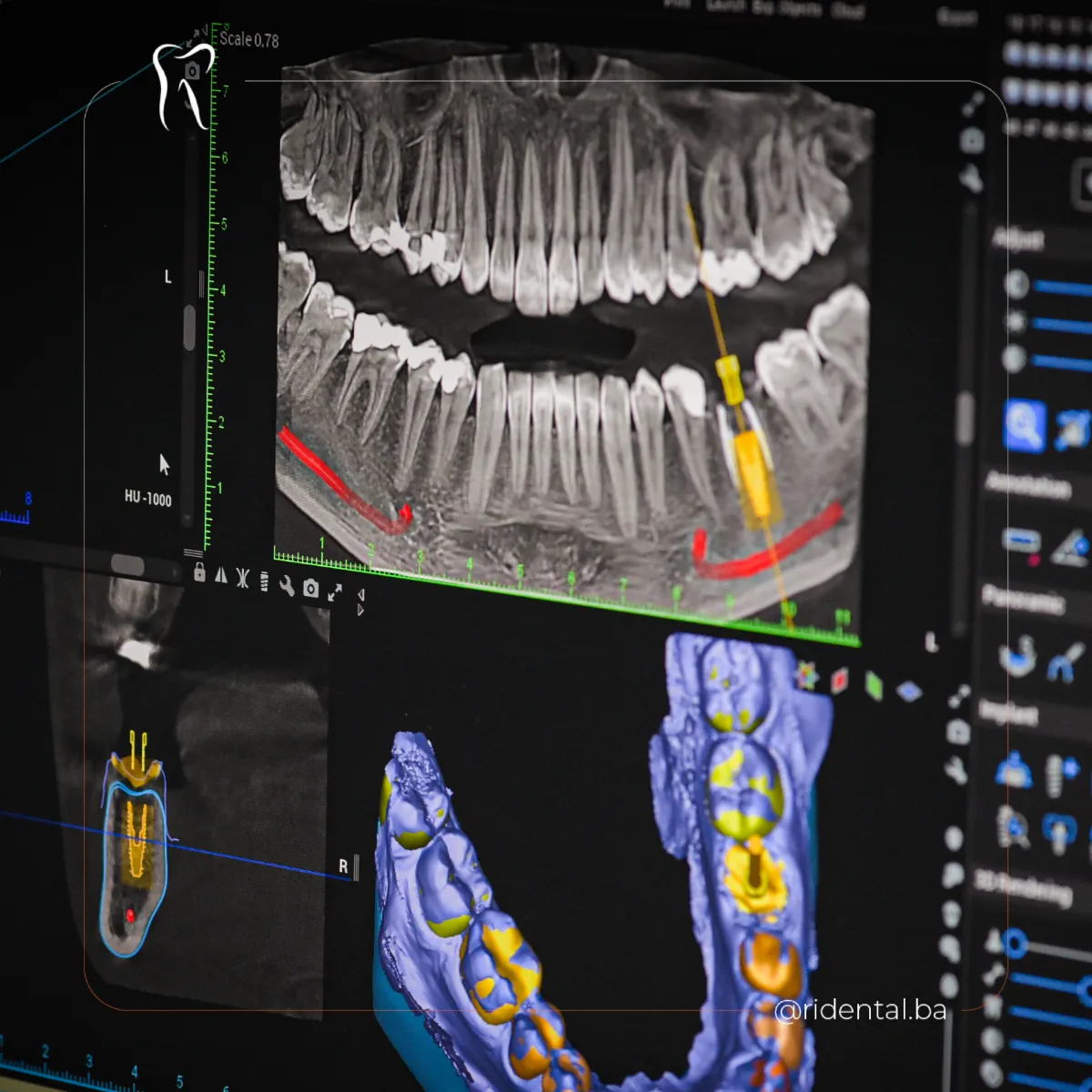 CBCT 3D snimak vilice, Planmeca, Cazin