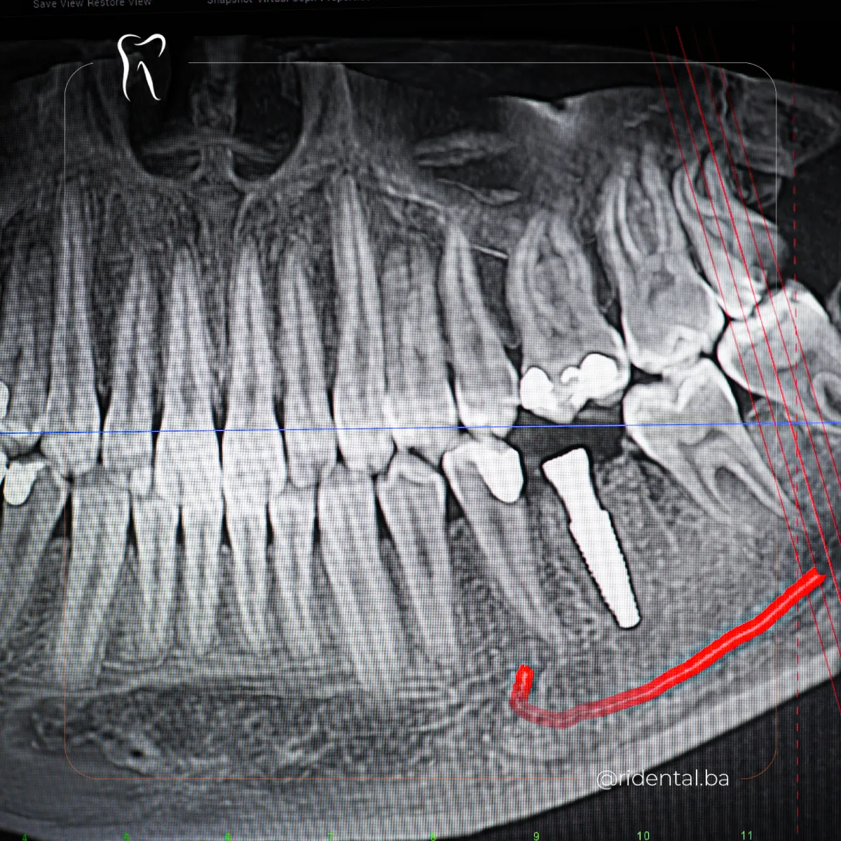 CBCT snimak ugrađenog implantata, dijagnostika Cazin, Ridental