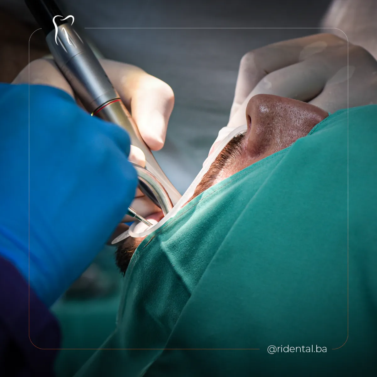 Implantološki zahvat, ugradnja zubnog implantata, Ridental Cazin