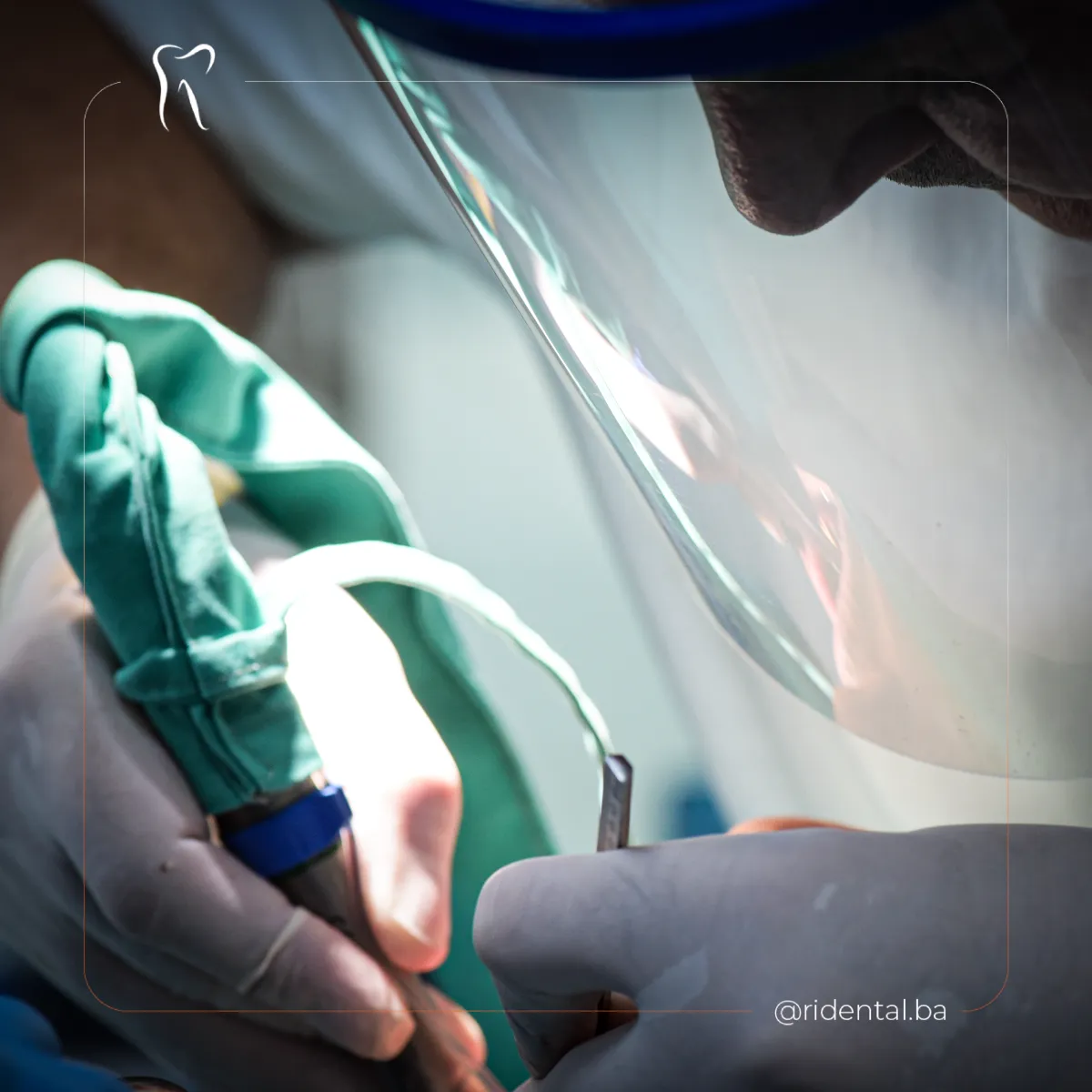 Oralnohirurški zahvat ugradnje implantata, dr. Osman Huskić, implantati Cazin, Ridental